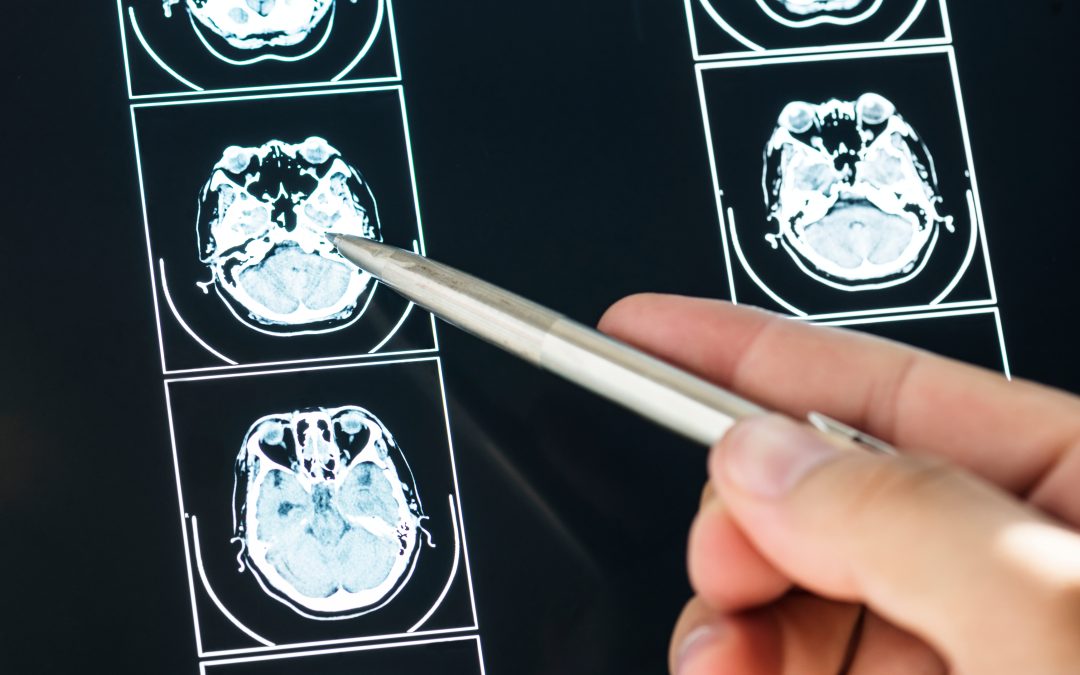 Creutzfeldt-Jakob disease
